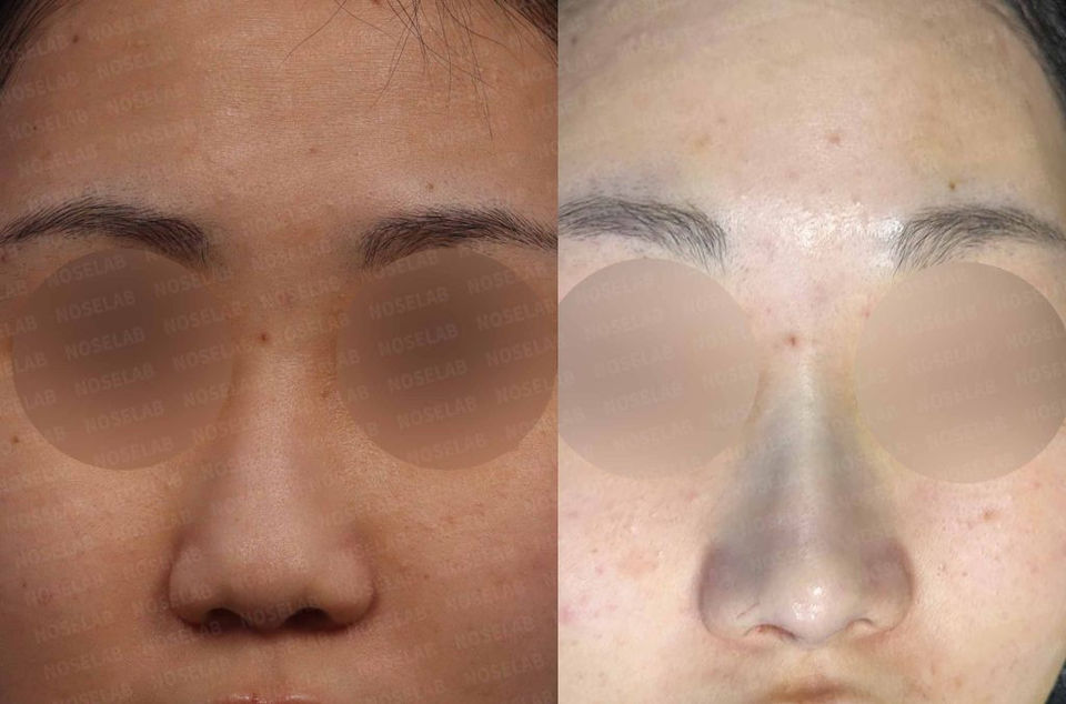 Before and after frontal photos showing improvement of nasal deviation and tip asymmetry through Deviated and Small Nose Correction – Closed Rhinoplasty Korea.