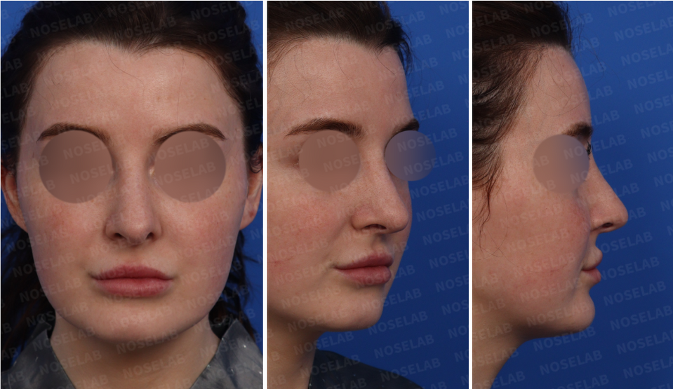 Preoperative design consultation, frontal view, 45-degree view and side profile view.