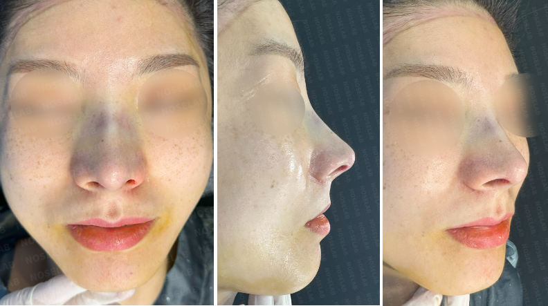 Photos taken immediately after surgery, frontal view, side profile and 45-angle view.