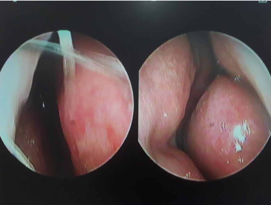 Endoscopic view of right and left nasal cavities before autologous rib cartilage rhinoplasty: showing septal deviation and inferior turbinate hypertrophy.