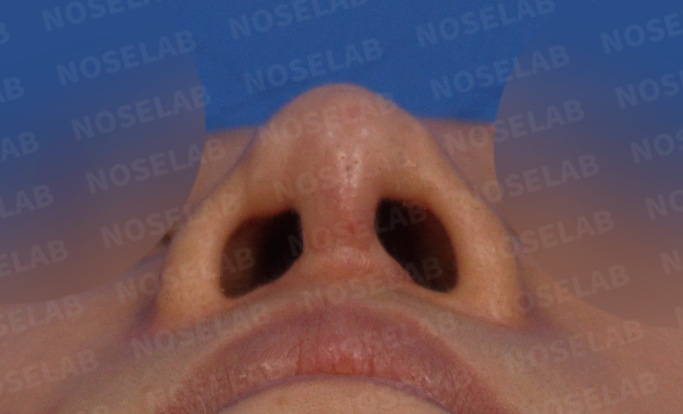 Nostril view before rhinoplasty – asymmetry shown before Illegal Filler Removal and Closed Rhinoplasty in Korea.