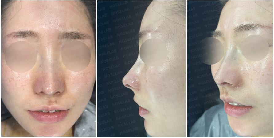 Immediately after surgery: frontal, side, and oblique side views showing refined nasal bridge, improved nasal tip projection, and balanced facial harmony – Nose Lab Clinic