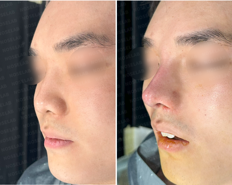 Enhancing nasal height & resolving nasal obstruction – pre- and immediate post-surgery right side and oblique side view photos of patient at Nose Lab Clinic.