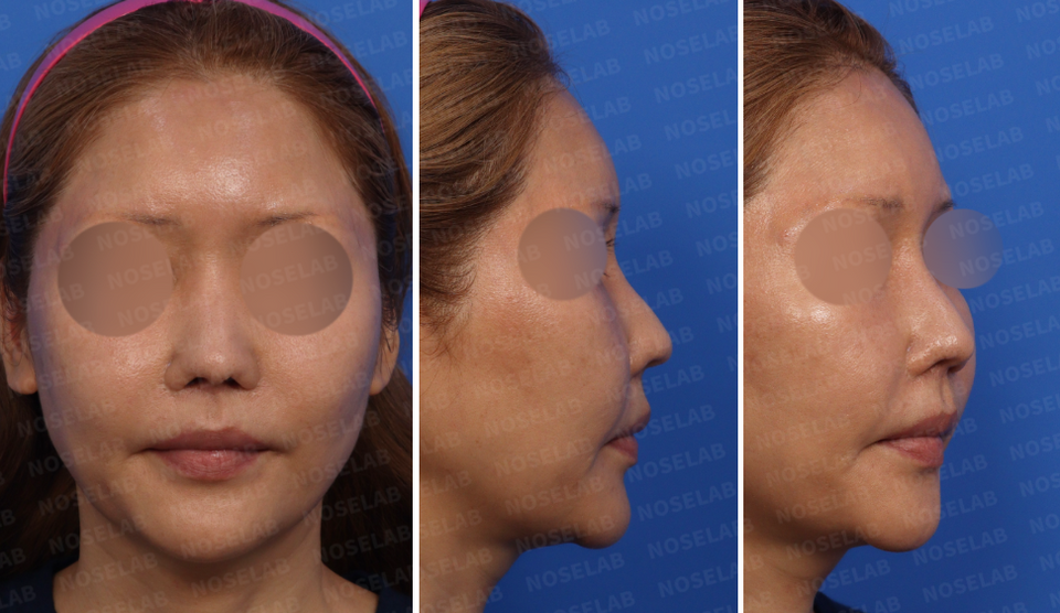 Preoperative design consultation, frontal view, 45-degree view and side profile view.