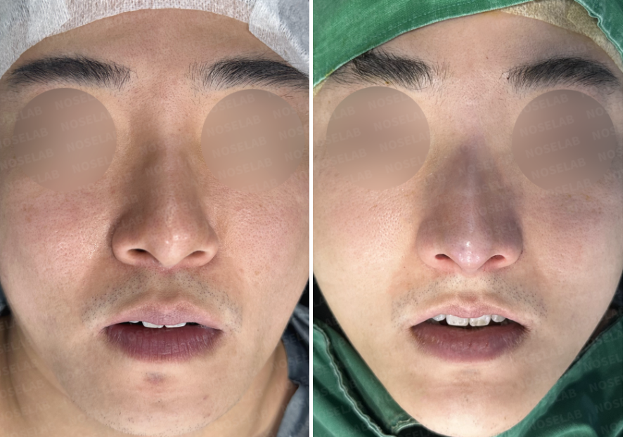 Before and immediately after frontal view showing correction of deviated nose and facial asymmetry with closed rhinoplasty Korea