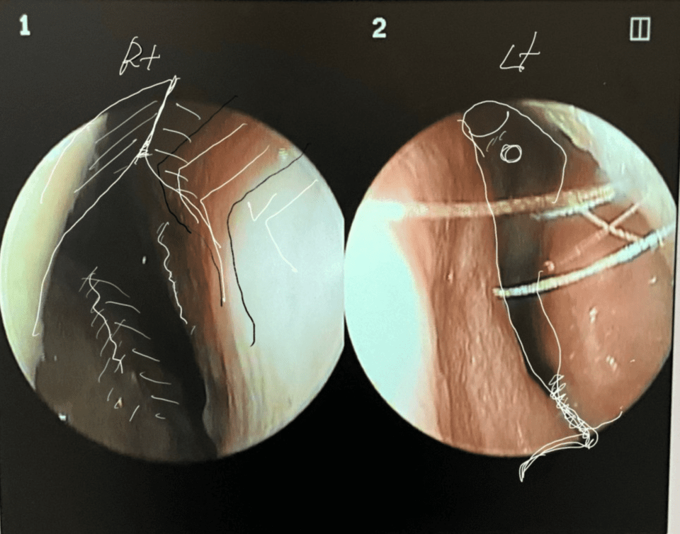 Endoscopic view of nasal cavity before nostril asymmetry correction, showing silicone implant deviation to the left and asymmetry of the nasal septum and bone structure.