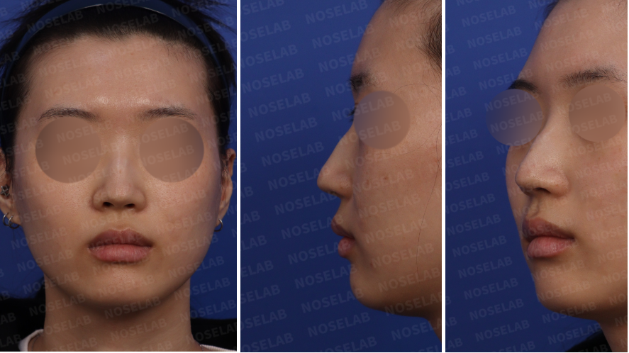 Preoperative design consultation for hump nose correction – frontal, left side, and oblique side view photos