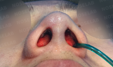 Photo of the nostrils