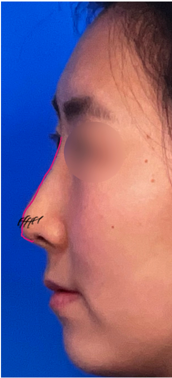 Side profile preoperative design photo showing drooping nasal tip and visible implant boundary.