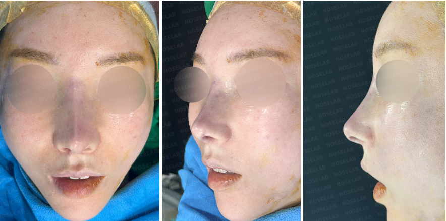 Immediately after revision rhinoplasty for severe nasal contracture – frontal, oblique side, and right side views showing improved nasal contour and columella support.