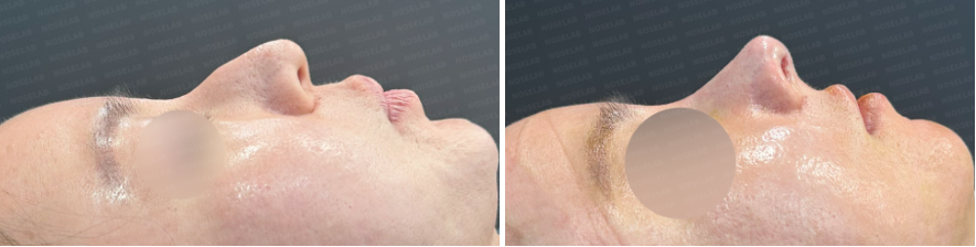 Side view before and immediately after droopy nose and hump correction rhinoplasty – showing improved nasal bridge and lifted tip.