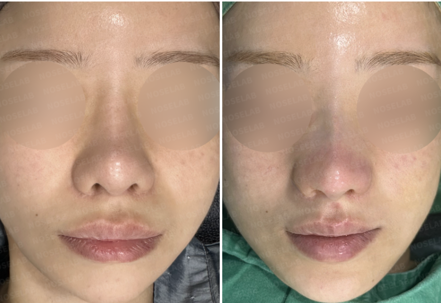 Before and after frontal view of revision rhinoplasty for deviated nose Korea