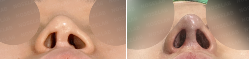 Before and immediately after surgery nostril base view comparison showing improved nostril symmetry and more stable nasal base after revision rhinoplasty with structural reconstruction.