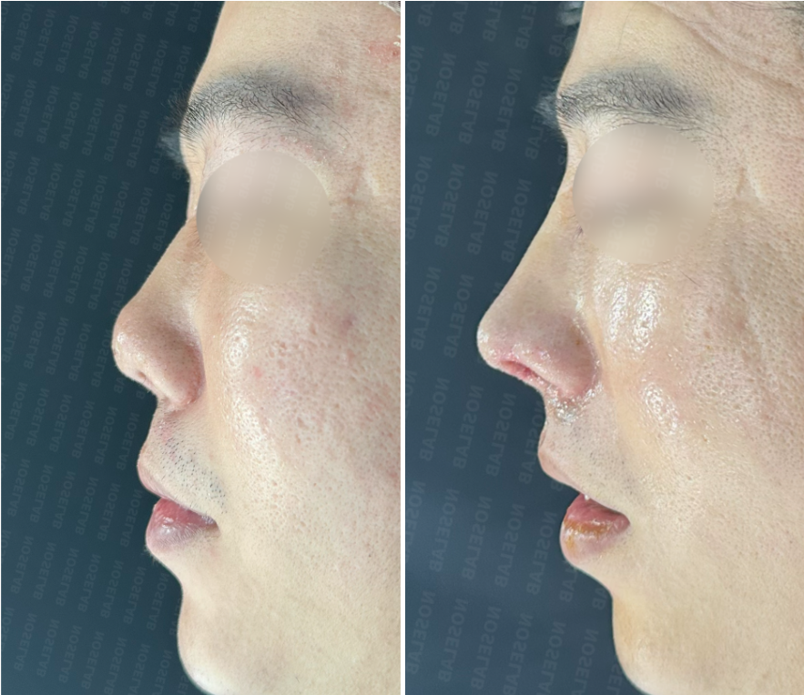 Side profile comparison before and immediately after nasal tip reconstruction surgery, highlighting improved projection and contour.