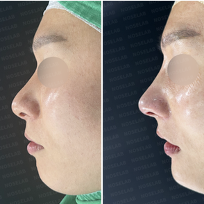 Before and after facial asymmetry correction, showing nasal bone restoration and balanced chin projection in side profile view.
