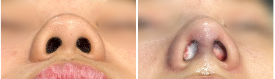 Before and after small blunt nose correction surgery – nostril/base view comparison