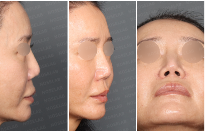 Preoperative right side, right oblique, and nostril views showing irregular nasal bridge before silicone implant revision rhinoplasty.