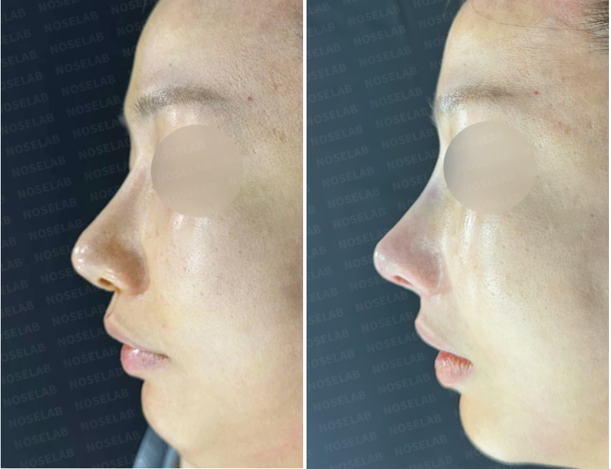Side profile before and immediately after revision rhinoplasty showing correction of nasal deviation, improved dorsal line, refined nasal tip, and balanced nasolabial angle
