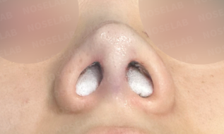 Nostril view immediately after straight-line nose surgery using autologous rib cartilage, showing improved columella projection and symmetry.