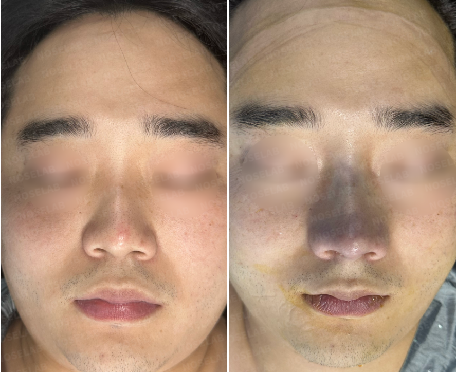 Before and after comparison – frontal view of a short and wide male nose before surgery (left) and immediate results after Male Rhinoplasty Korea with closed rhinoplasty (right), showing refined nasal tip, improved proportions, and balanced nostrils.