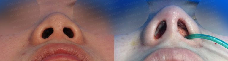 Nostrils asymmetry correction