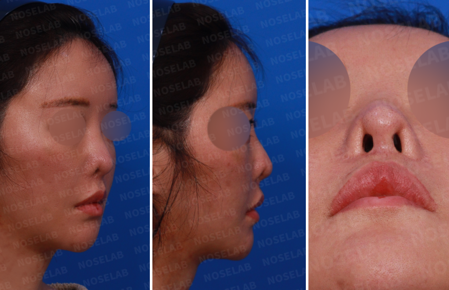 Corrective rhinoplasty after nostril reduction – preoperative consultation photos showing right side, right oblique, and nostril views