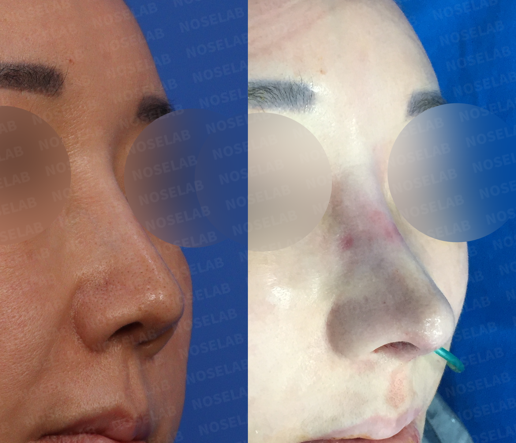 Three-quarter angle view showing balanced nasal contours and harmonious facial proportions following reconstructive rhinoplasty