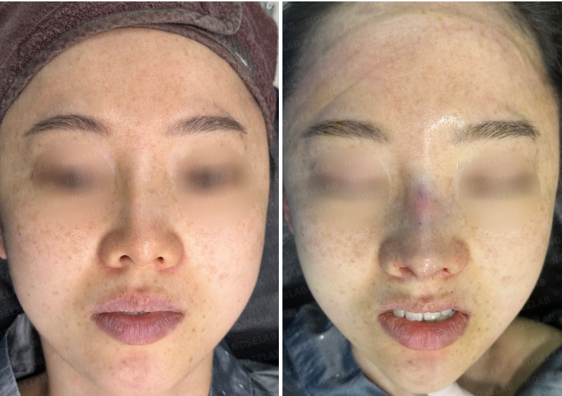 Before and after frontal photos showing corrected nostril asymmetry and balanced nose tip shape.