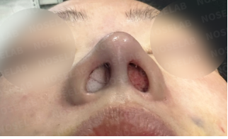 Immediately after surgery – nostril base view showing corrected asymmetry and tip support following revision rhinoplasty using rib cartilage.