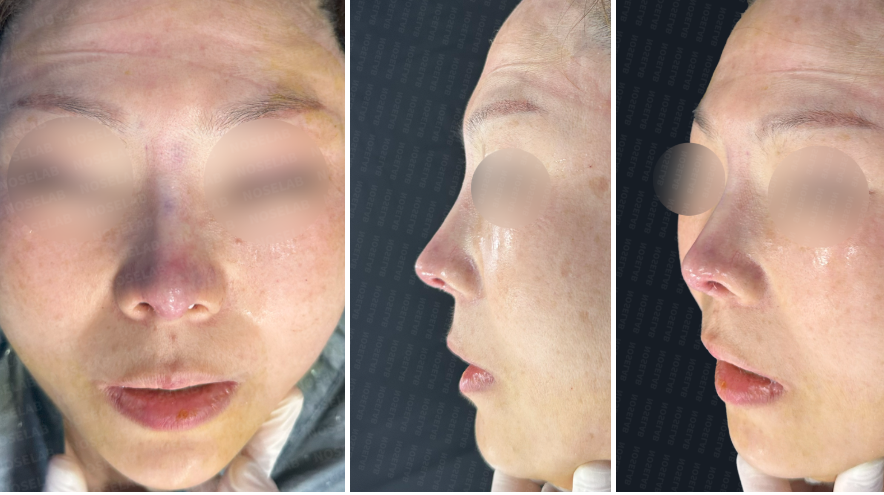 Immediately after contracted nose correction: frontal, side, and oblique view photos