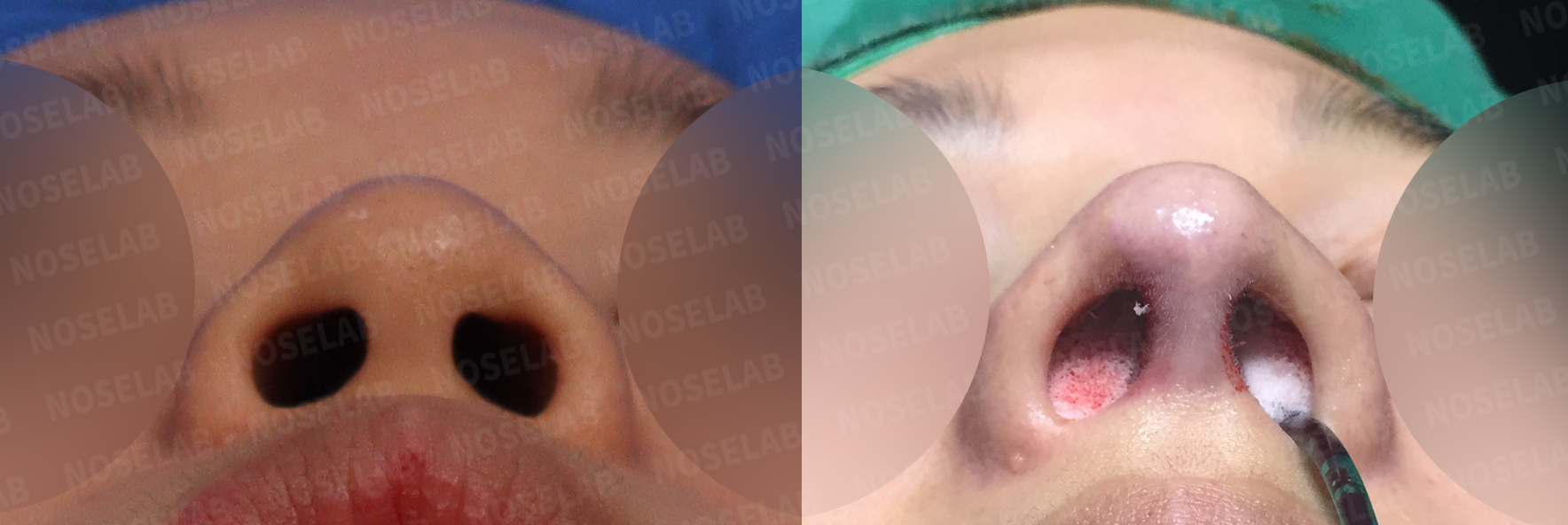 Base view comparison showing nostril shape refinement from round to elegant oval contour