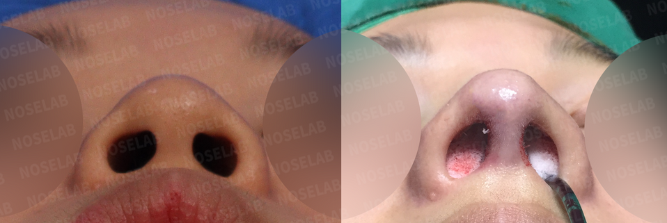 closed rhinoplasty Korea before and after basal view – nostril asymmetry correction and refined nasal tip contour using self rib cartilage