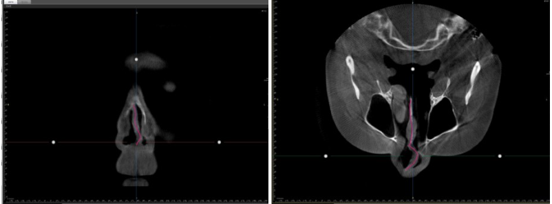 Preoperative CT scans showing deviated septal cartilage (red) leaning to the side and narrowing the left nasal passage (black)