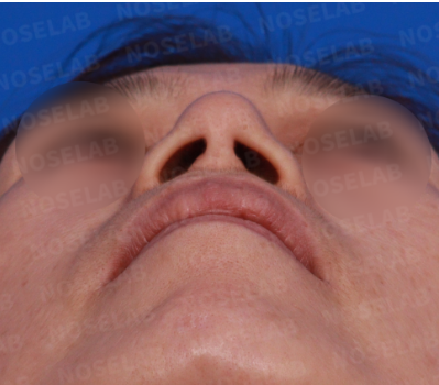 Before Surgery – Nostril View: The nostrils appear wide and slightly asymmetric, with a drooping nasal tip contributing to imbalance.