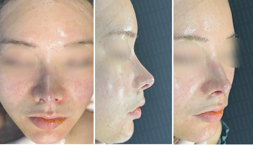 Photos immediately after surgery – combined frontal, side, and oblique side views after Revision Rhinoplasty Korea with closed approach, showing refined nasal tip, straightened bridge, and improved facial balance.