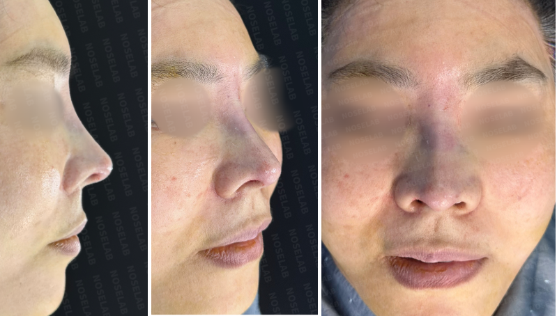 After surgery photos of droopy nose correction: side profile, 45-degree view, and frontal view showing improved nasal bridge, refined tip, and better nostril balance.