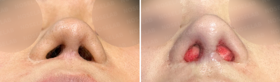 Nostrils before surgery (left) after surgery (right)