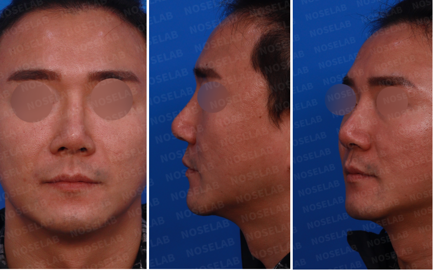 Preoperative design consultation – frontal, left side, and oblique side view photos for deviated nose correction
