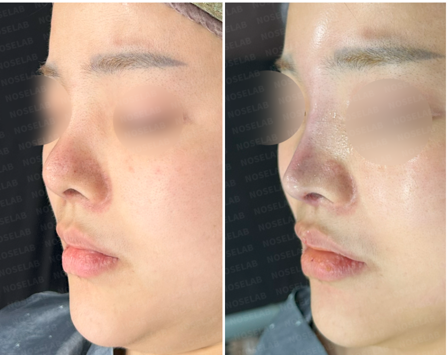 Immediately after upturned nose correction using autologous rib cartilage – oblique view showing improved nasal tip rotation and balanced profile"