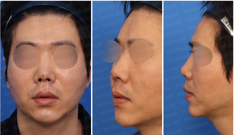 Frontal, left-side, and oblique side view photos of a male patient taken during pre-surgical design consultation for revision rhinoplasty at Nose Lab Clinic.