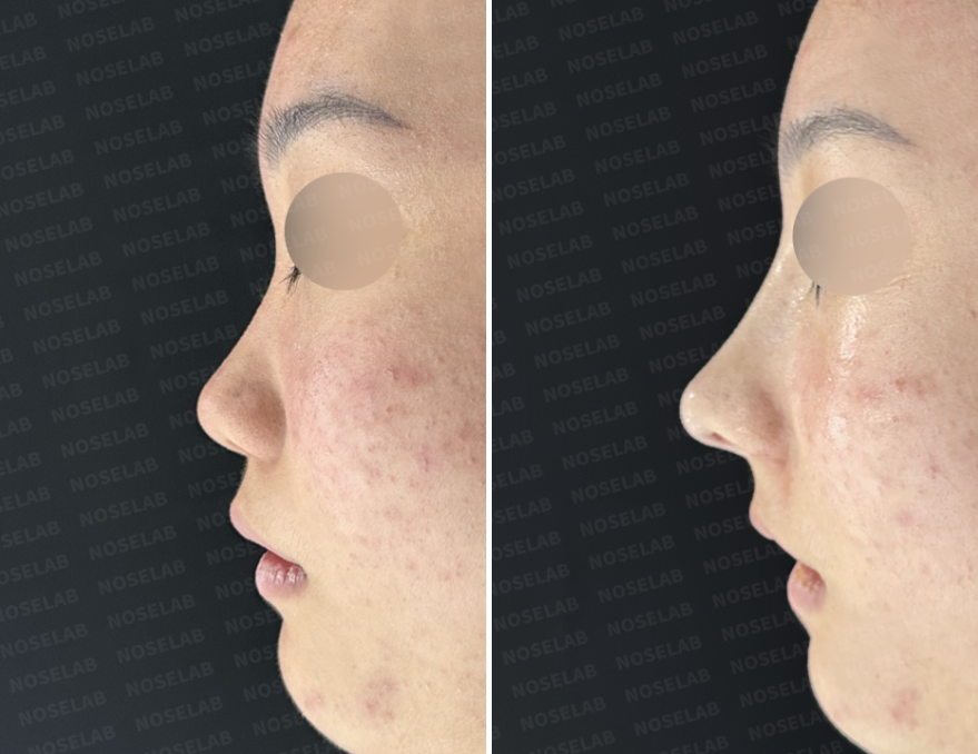 Before and immediately after closed rhinoplasty side view showing increased nasal bridge height, refined nasal tip contour, and improved nasolabial angle using autologous rib cartilage.
