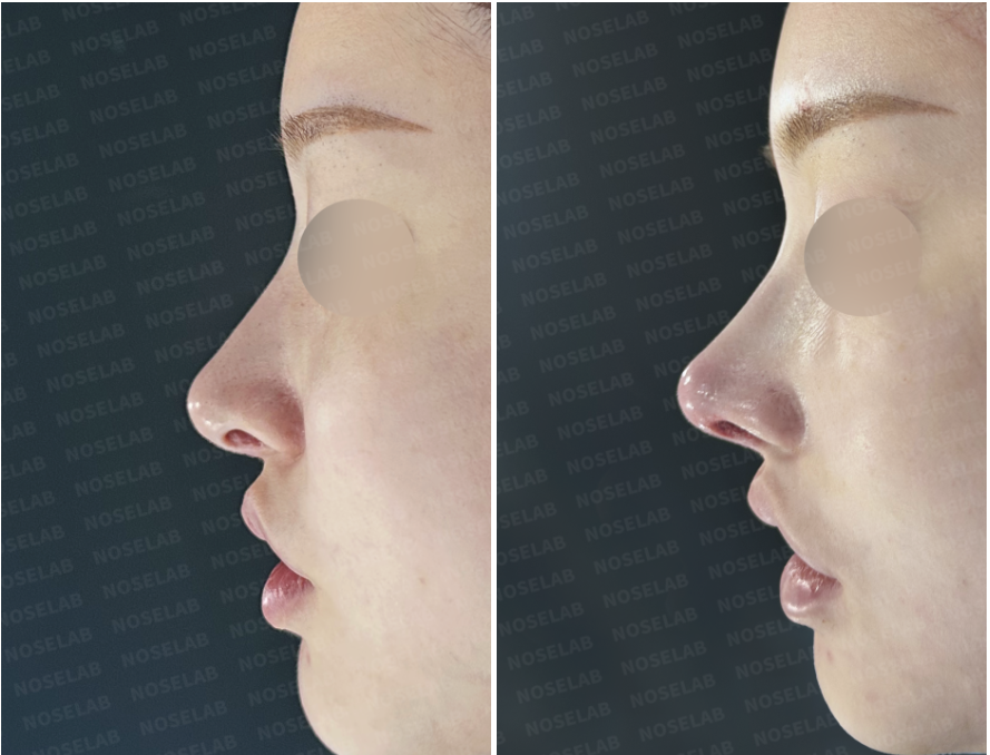Before and immediately after closed rhinoplasty Korea, side profile comparison showing improved nasal bridge alignment, refined tip projection, corrected nasolabial angle, and a smoother, more natural bridge-to-tip contour following structural reconstruction.