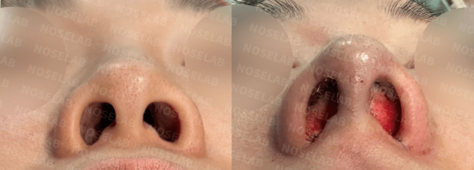 Before and after nostril base view – improved nasal symmetry and tip projection after bumpy and deviated nose correction using self-rib cartilage through closed rhinoplasty (Noselab Clinic)