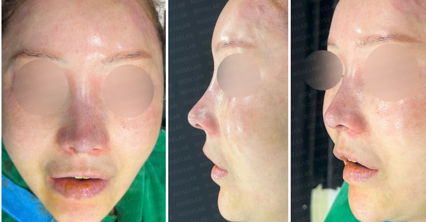 Immediate postoperative photos after contracted nose reconstruction using autologous rib cartilage: frontal, side, and oblique views showing improved nasal tip definition and dorsal line.