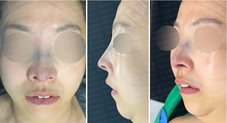 Frontal, side, and oblique view immediately after closed rhinoplasty for upturned nose and nostril correction.
