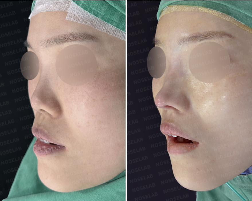 Before and immediately after short nose correction, oblique side view showing improved nasal projection, smoother bridge line, and natural tip contour.