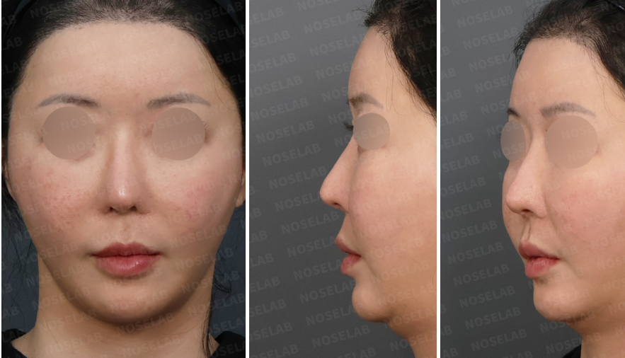 Preoperative design consultation images showing frontal view, left oblique side view, and left lateral view of a patient with nostril asymmetry and suspected septal deviation following previous rhinoplasty.