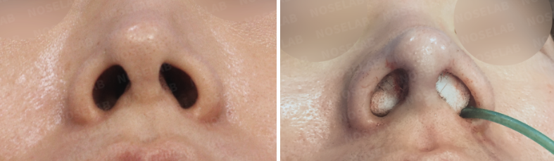Nostrils before (left) and after Closed Rhinoplasty Korea (right), showing improved nostril asymmetry and straighter columella alignment.