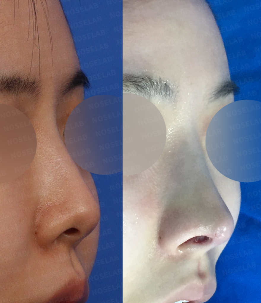 Three-quarter angle view showing balanced nasal projection and refined tip definition after autologous cartilage rhinoplasty