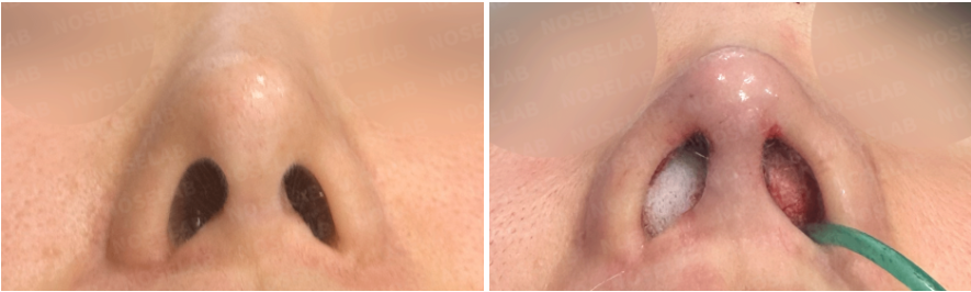 Nostril view before (left) and immediately after surgery (right), showing correction of asymmetry and internal valve reopening using rib cartilage graft.